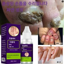 발톱연화제 무좀 티눈 네일 곰팡이 치료 세럼 손발톱 진균증 감염 방지 발 관리 에센스 제거 발가락 액체, 04 40ml