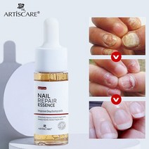 무좀 내성발톱 발톱무좀 ARTISCARE 네일 곰팡이 치료 발 관리 에센스 발가락 수리 세럼 제거 젤 감염 방지, 한개옵션0