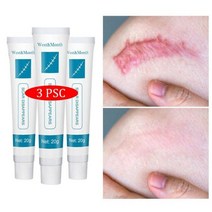 바디크림 피부크림 여드름크림 3pcs 허브 제거 크림 젤 스트레치 마크 제거 반점 화상, 3개