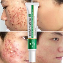 CAICHEN 효과적인 여드름제거 크림 허브 여드름 스팟 오일 컨트롤 여드름 크림 스킨케어 화이트닝 모이스처라이징 페이스 젤 스킨케어 20g|얼굴 셀프 태너