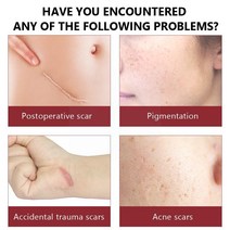 30ml 세럼 흉터 리페어 여드름 치료 모공 수축 스팟용 미백 브라이트닝 페이스 스킨 케어 e3라이트 완화, [01] A