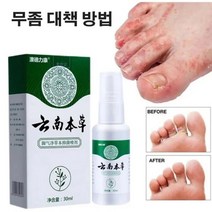 Yq 1+1+1 항균 무좀 스프레이 발톱 풋케어 발냄새 제거 살균 30ml 3개