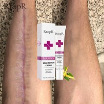 피부 스카 진정 크림 얼굴 페이드 스카 크림 트러블 반점 트러블 치료 블랙헤드 화이트닝 크림 스카 스트레치 마크 뷰티