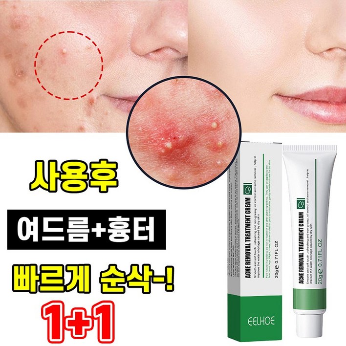 [당일배송] 1+1 여드름 제거 연고 흉터 리페어 크림 얼굴 뾰루지 치료 문제피부 케어연고